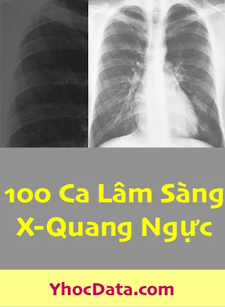 YhocData XQ Ngực